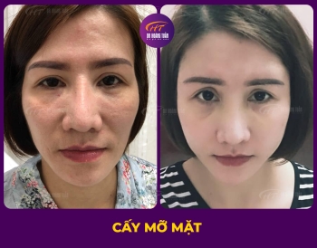CẤY MỠ
